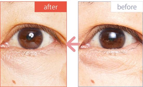 ちりめんジワ対策 マイクロニードルパッチ の効果は Ldk が紹介 360life サンロクマル