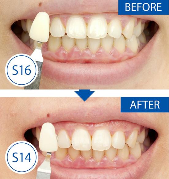 【2022】歯のホワイトニングおすすめ22選｜雑誌『LDK』が比較 